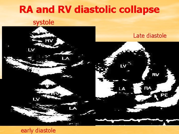 RA and RV diastolic collapse systole Late diastole early diastole 