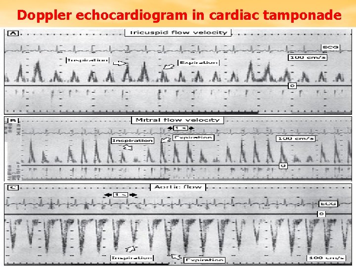 Doppler echocardiogram in cardiac tamponade 