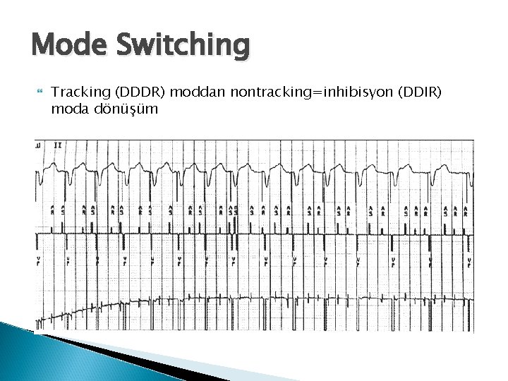 Mode Switching Tracking (DDDR) moddan nontracking=inhibisyon (DDIR) moda dönüşüm 