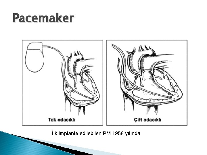 Pacemaker İlk implante edilebilen PM 1958 yılında 