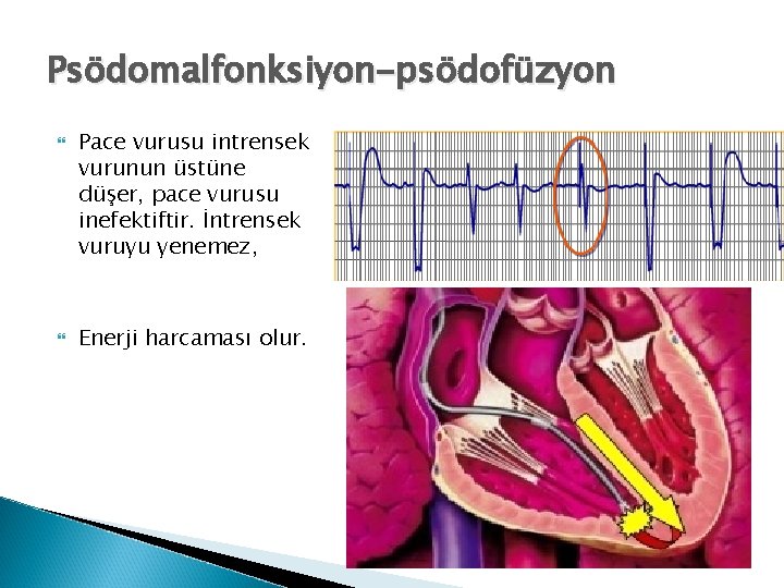 Psödomalfonksiyon-psödofüzyon Pace vurusu intrensek vurunun üstüne düşer, pace vurusu inefektiftir. İntrensek vuruyu yenemez, Enerji