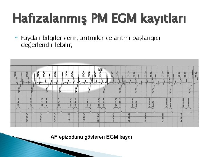 Hafızalanmış PM EGM kayıtları Faydalı bilgiler verir, aritmiler ve aritmi başlangıcı değerlendirilebilir, AF epizodunu