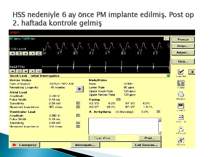 HSS nedeniyle 6 ay önce PM implante edilmiş. Post op 2. haftada kontrole gelmiş