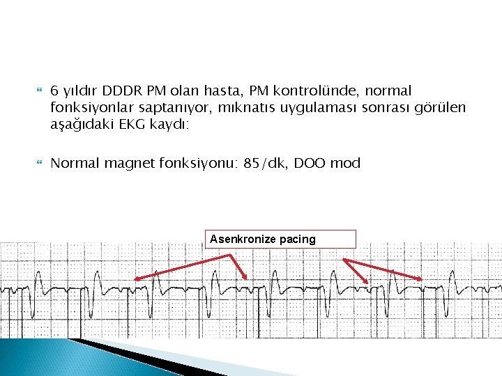  6 yıldır DDDR PM olan hasta, PM kontrolünde, normal fonksiyonlar saptanıyor, mıknatıs uygulaması