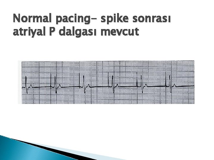 Normal pacing- spike sonrası atriyal P dalgası mevcut 