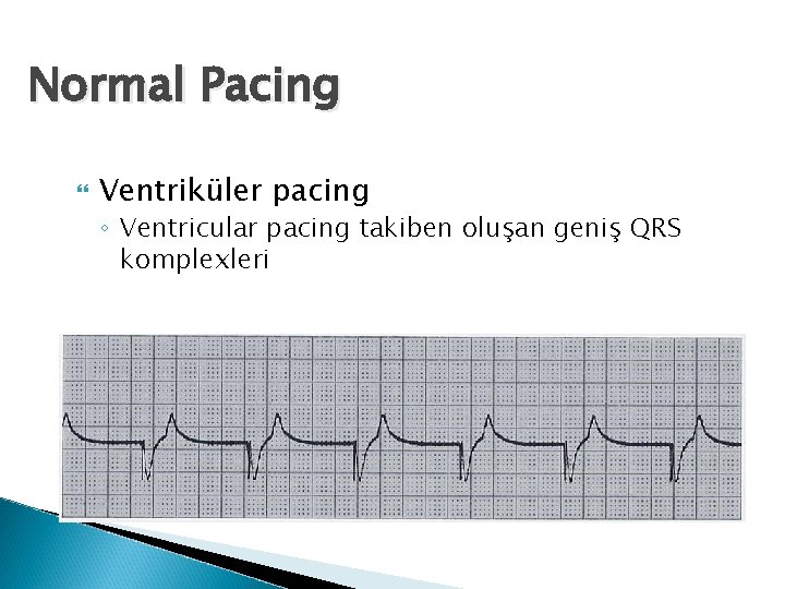 Normal Pacing Ventriküler pacing ◦ Ventricular pacing takiben oluşan geniş QRS komplexleri 
