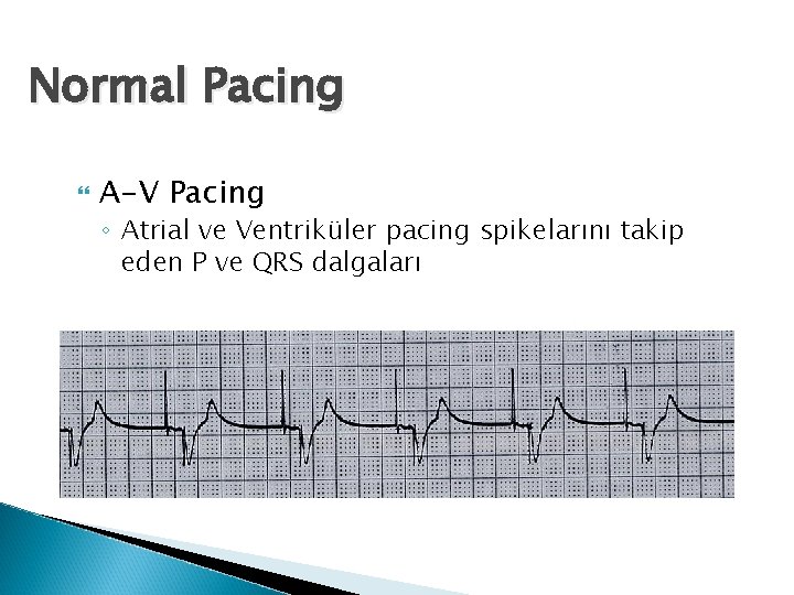 Normal Pacing A-V Pacing ◦ Atrial ve Ventriküler pacing spikelarını takip eden P ve