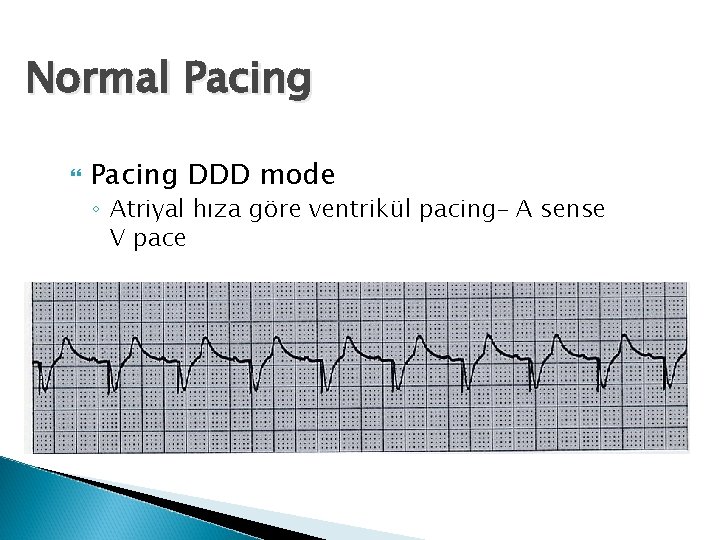 Normal Pacing DDD mode ◦ Atriyal hıza göre ventrikül pacing– A sense V pace