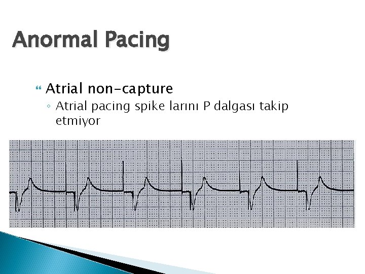 Anormal Pacing Atrial non-capture ◦ Atrial pacing spike larını P dalgası takip etmiyor 