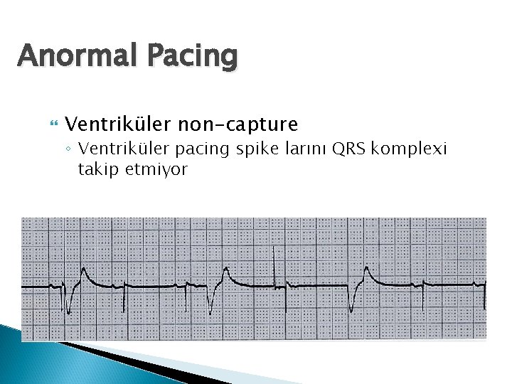 Anormal Pacing Ventriküler non-capture ◦ Ventriküler pacing spike larını QRS komplexi takip etmiyor 