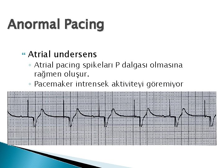 Anormal Pacing Atrial undersens ◦ Atrial pacing spikeları P dalgası olmasına rağmen oluşur. ◦