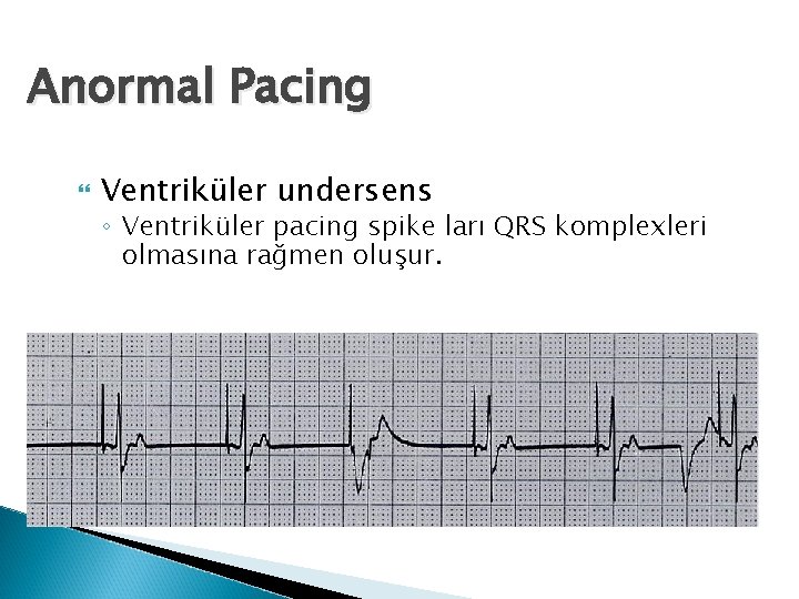 Anormal Pacing Ventriküler undersens ◦ Ventriküler pacing spike ları QRS komplexleri olmasına rağmen oluşur.