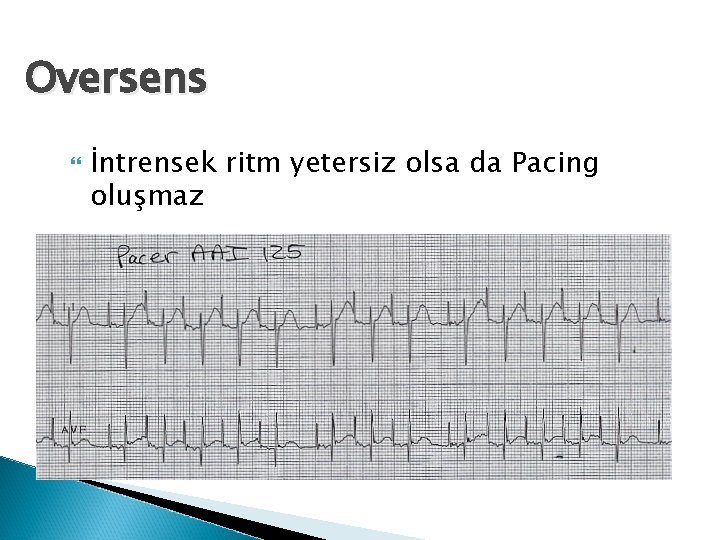 Oversens İntrensek ritm yetersiz olsa da Pacing oluşmaz 