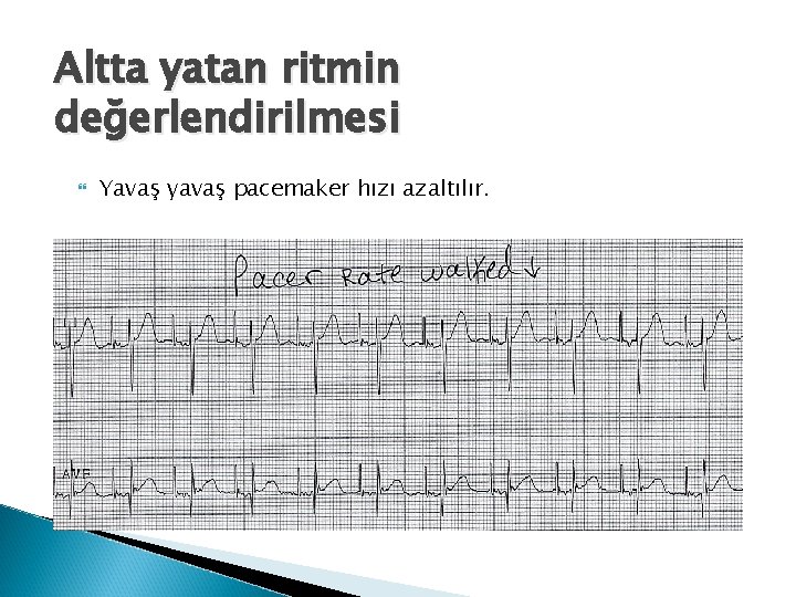 Altta yatan ritmin değerlendirilmesi Yavaş yavaş pacemaker hızı azaltılır. 