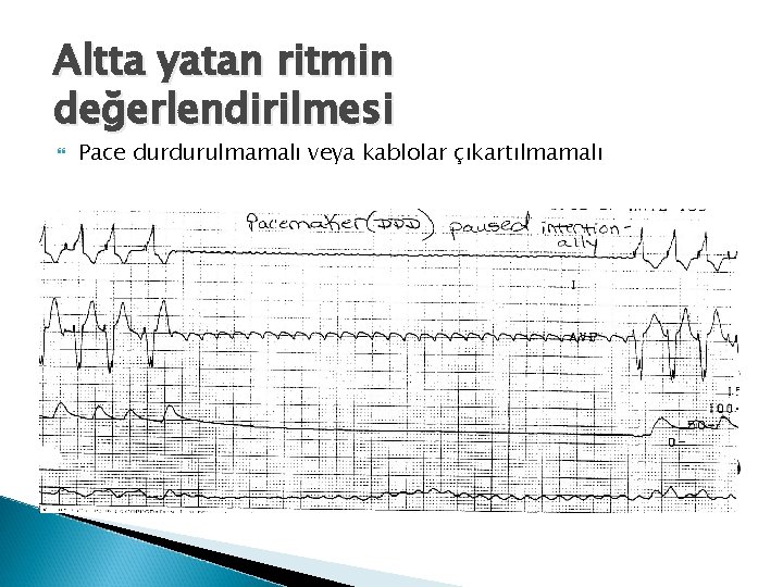 Altta yatan ritmin değerlendirilmesi Pace durdurulmamalı veya kablolar çıkartılmamalı 