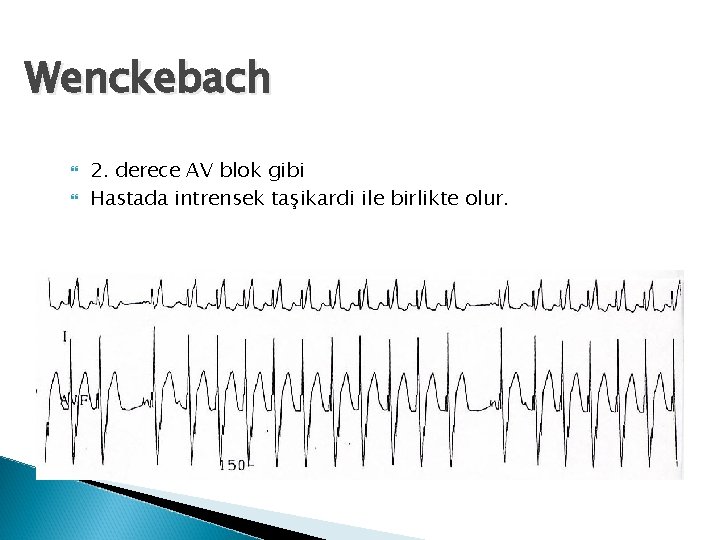 Wenckebach 2. derece AV blok gibi Hastada intrensek taşikardi ile birlikte olur. 