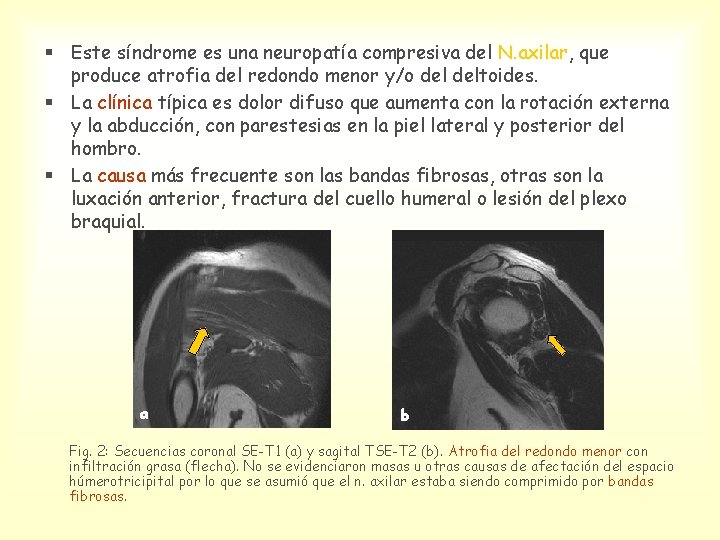 § Este síndrome es una neuropatía compresiva del N. axilar, que produce atrofia del