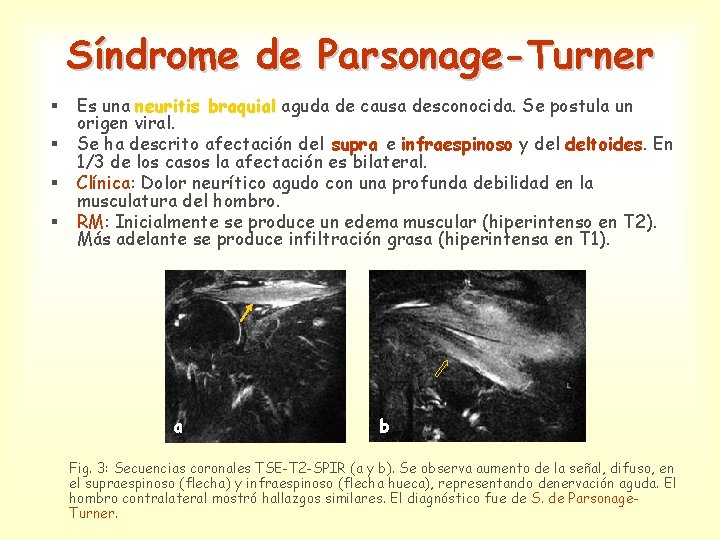 Síndrome de Parsonage-Turner § § Es una neuritis braquial aguda de causa desconocida. Se
