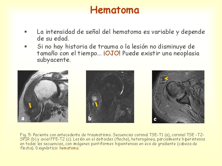 Hematoma § § a La intensidad de señal del hematoma es variable y depende