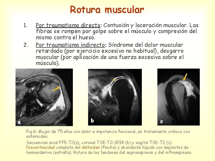 Rotura muscular 1. 2. Por traumatismo directo: Contusión y laceración muscular. Las fibras se