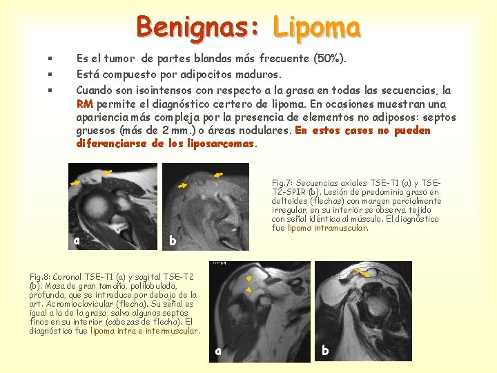Benignas: Lipoma § § § Es el tumor de partes blandas más frecuente (50%).
