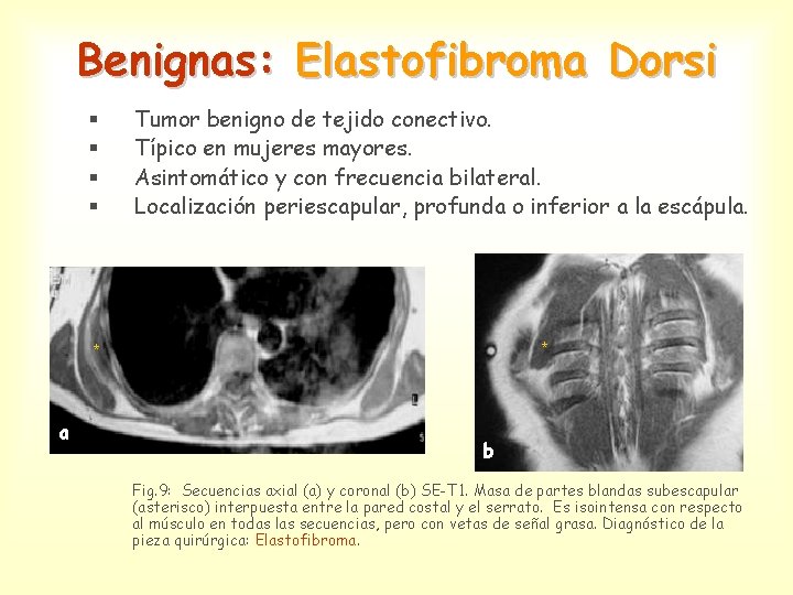Benignas: Elastofibroma Dorsi § § Tumor benigno de tejido conectivo. Típico en mujeres mayores.