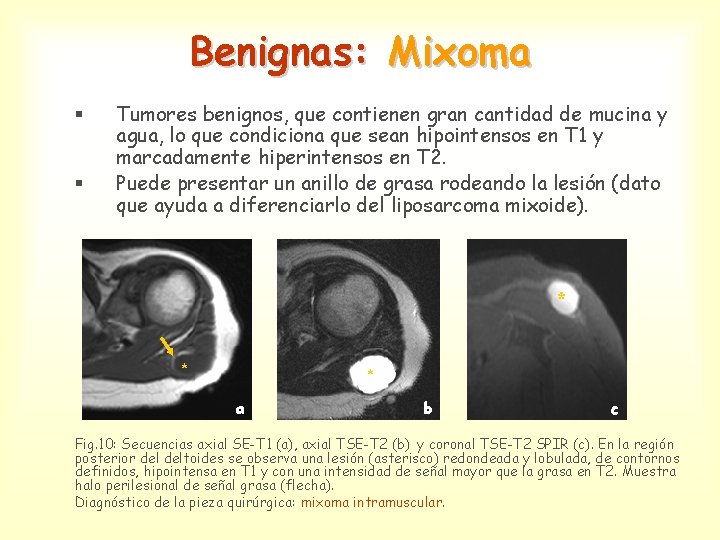 Benignas: Mixoma § § Tumores benignos, que contienen gran cantidad de mucina y agua,