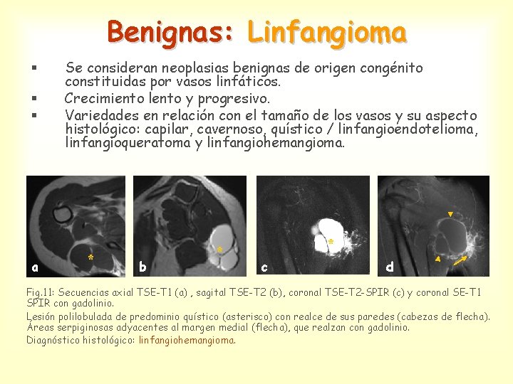 Benignas: Linfangioma § § § a Se consideran neoplasias benignas de origen congénito constituidas