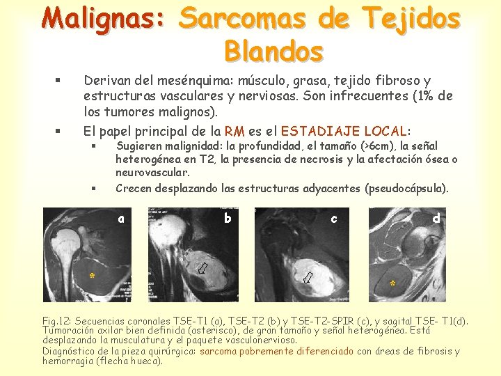 Malignas: Sarcomas de Tejidos Blandos § § Derivan del mesénquima: músculo, grasa, tejido fibroso