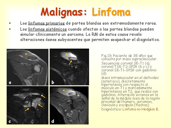 Malignas: Linfoma § § Los linfomas primarios de partes blandas son extremadamente raros. Los