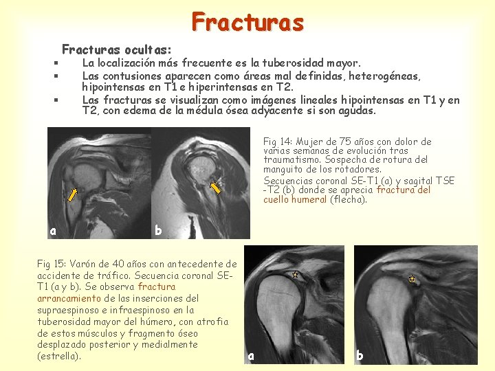 Fracturas § § § Fracturas ocultas: La localización más frecuente es la tuberosidad mayor.