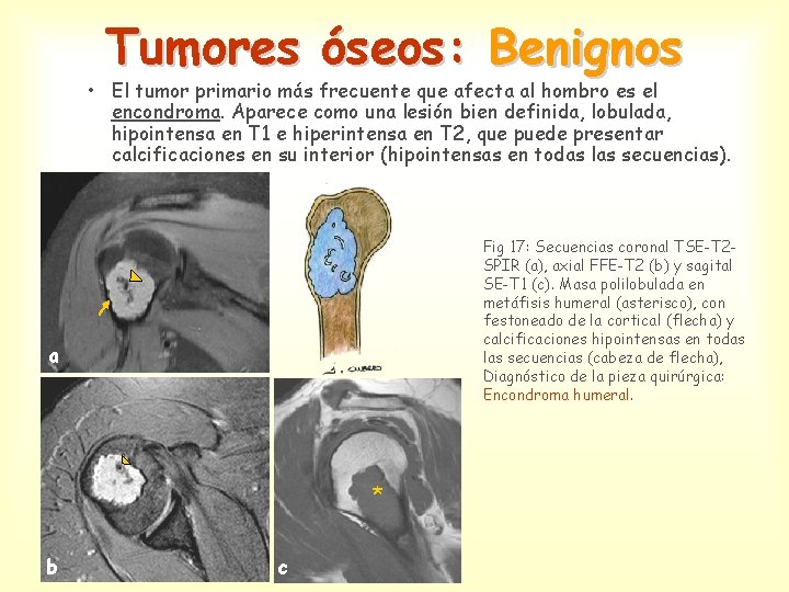 Tumores óseos: Benignos • El tumor primario más frecuente que afecta al hombro es