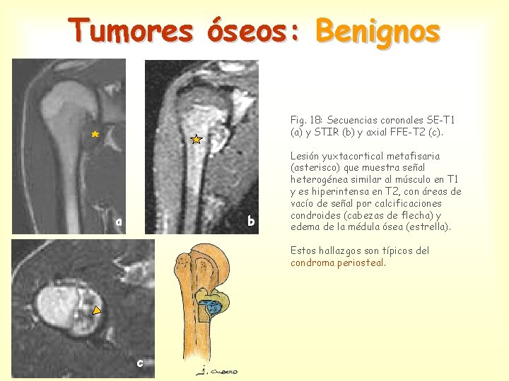 Tumores óseos: Benignos Fig. 18: Secuencias coronales SE-T 1 (a) y STIR (b) y