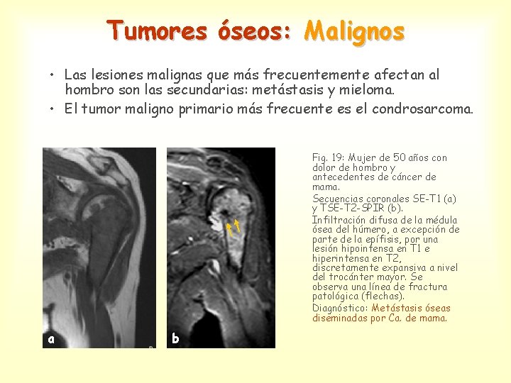 Tumores óseos: Malignos • Las lesiones malignas que más frecuentemente afectan al hombro son