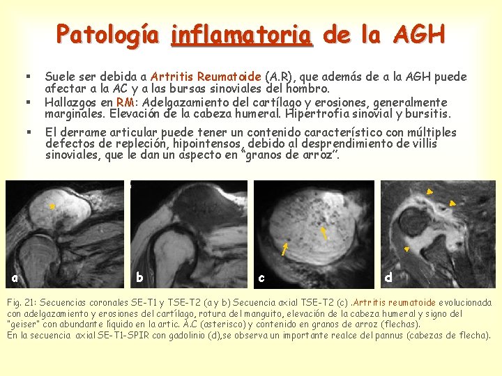 Patología inflamatoria de la AGH § § § Suele ser debida a Artritis Reumatoide