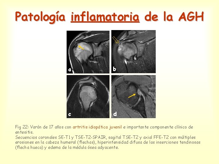 Patología inflamatoria de la AGH a b c d Fig 22: Varón de 17