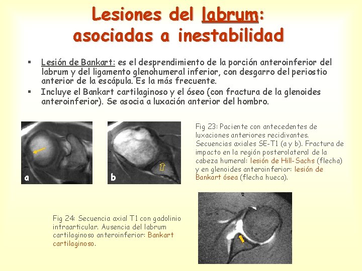 Lesiones del labrum: asociadas a inestabilidad § § a Lesión de Bankart: es el