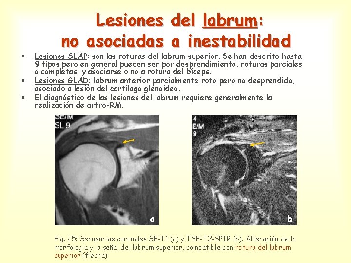 § § § Lesiones del labrum: no asociadas a inestabilidad Lesiones SLAP: son las