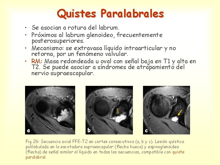 Quistes Paralabrales • Se asocian a rotura del labrum. • Próximos al labrum glenoideo,