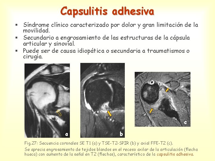 Capsulitis adhesiva § Síndrome clínico caracterizado por dolor y gran limitación de la movilidad.