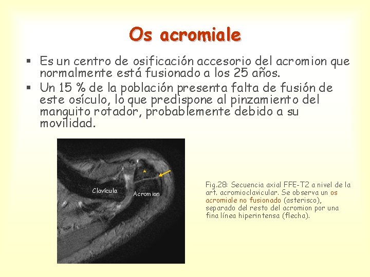 Os acromiale § Es un centro de osificación accesorio del acromion que normalmente está