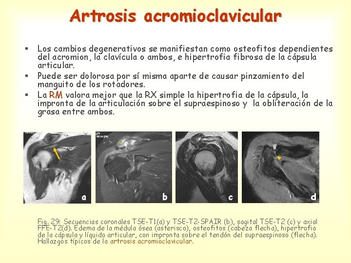 Artrosis acromioclavicular § § § Los cambios degenerativos se manifiestan como osteofitos dependientes del