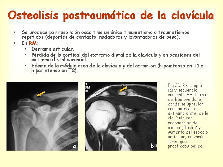 Osteolisis postraumática de la clavícula § § Se produce por resorción ósea tras un