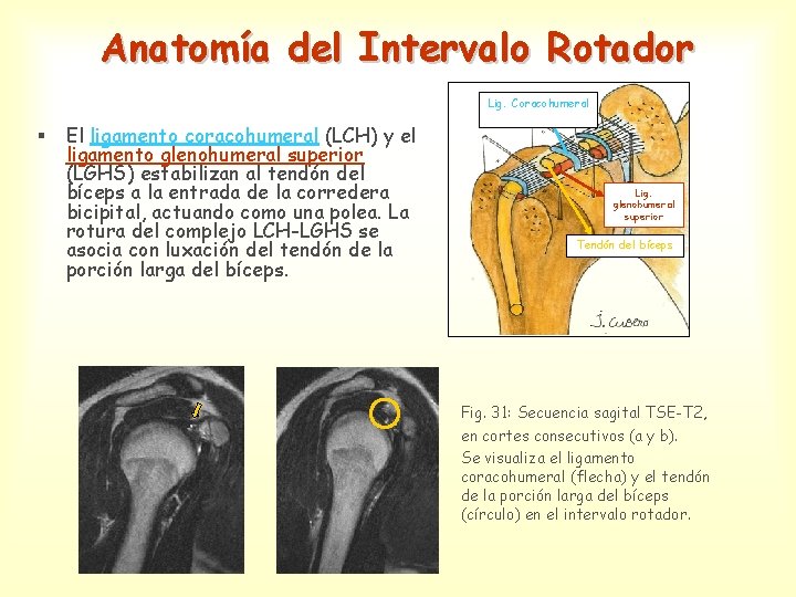 Anatomía del Intervalo Rotador Lig. Coracohumeral § El ligamento coracohumeral (LCH) y el ligamento