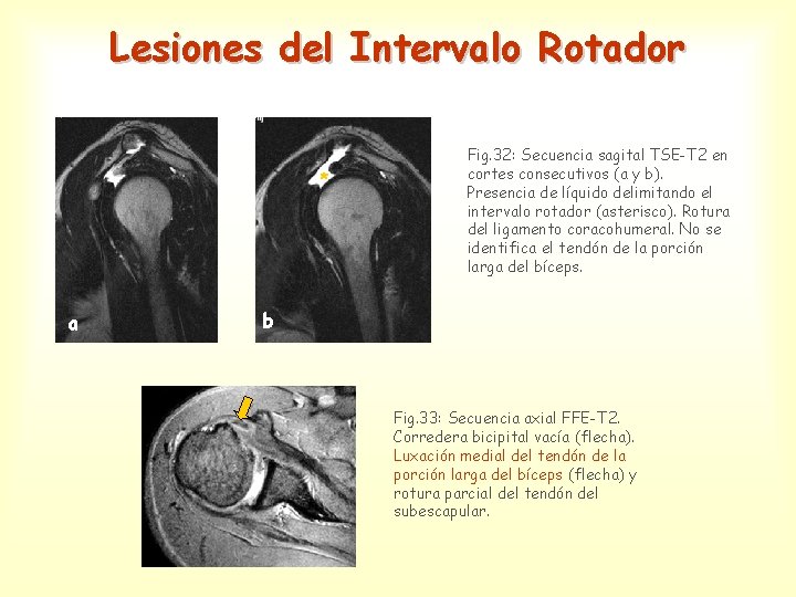 Lesiones del Intervalo Rotador * a Fig. 32: Secuencia sagital TSE-T 2 en cortes