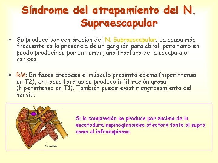 Síndrome del atrapamiento del N. Supraescapular § Se produce por compresión del N. Supraescapular.