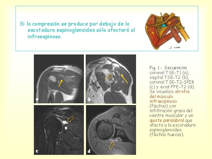 Si la compresión se produce por debajo de la escotadura espinoglenoidea sólo afectará al