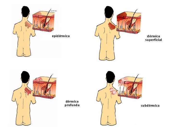 epidérmica profunda dérmica superficial subdérmica 