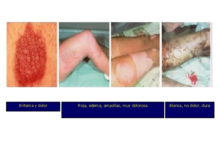 Eritema y dolor Roja, edema, ampollas, muy dolorosa Blanca, no dolor, dura 
