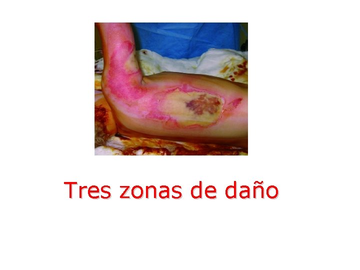 Tres zonas de daño 